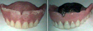 総入れ歯の症例