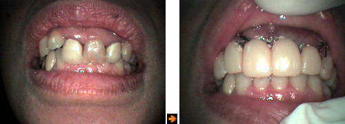 歯肉と歯槽骨の整形の症例１