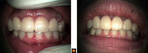 歯肉の整形の症例