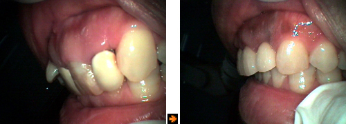 歯ぐきと歯槽骨の整形の症例