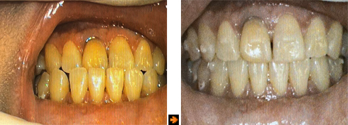invisa24cf