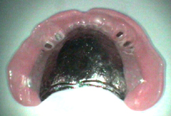 磁石式入れ歯症例