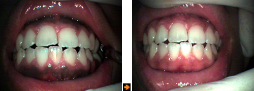 メラニン色素による歯ぐきの黒ずみ症例