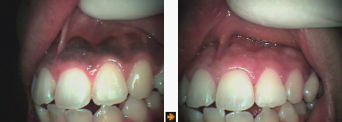 歯ぐきの黒ずみ除去の症例
