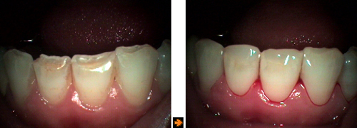 歯を削らない治療の症例