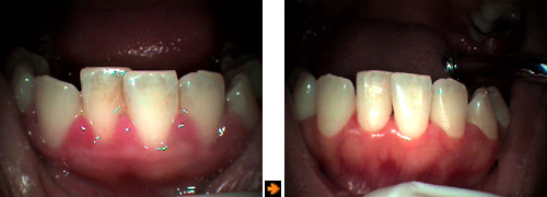 歯周病初期の症例１