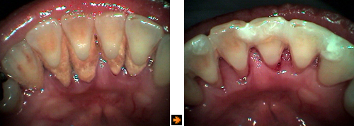 歯周病初期の症例２