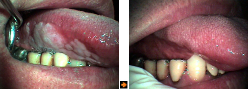 舌にできた前癌の症例